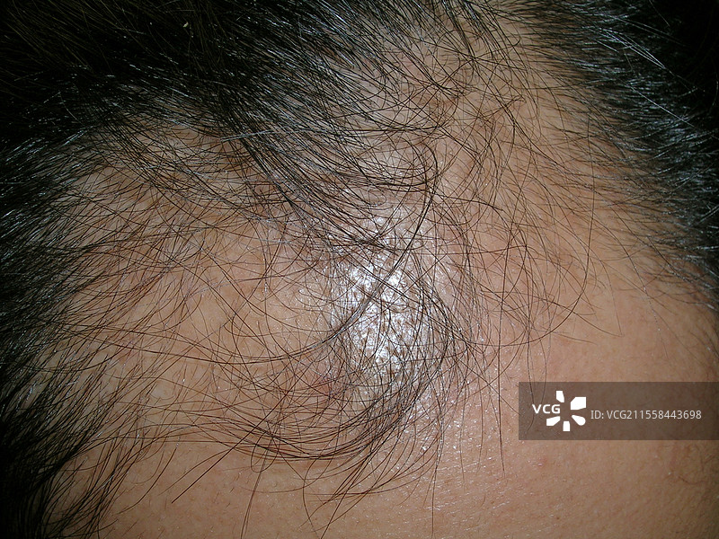 女性型脱发图片素材