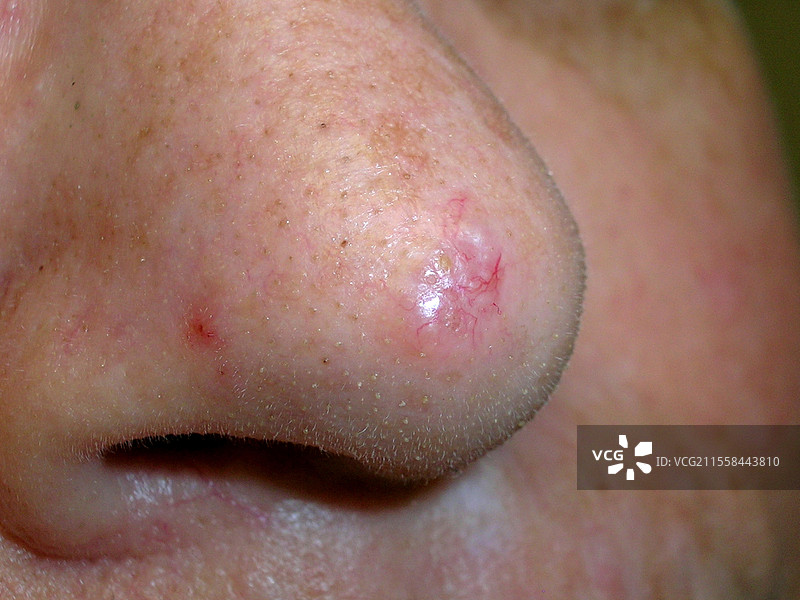 基底细胞癌图片素材