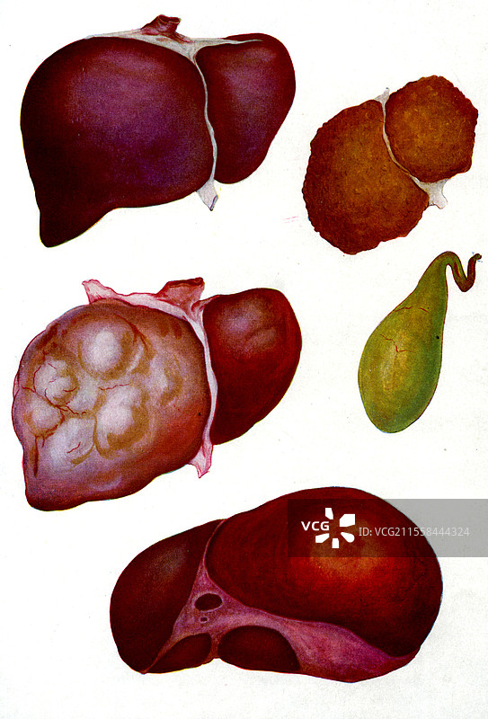 肝脏疾病插图图片素材