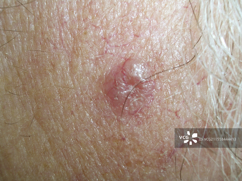 结节性基底细胞癌图片素材