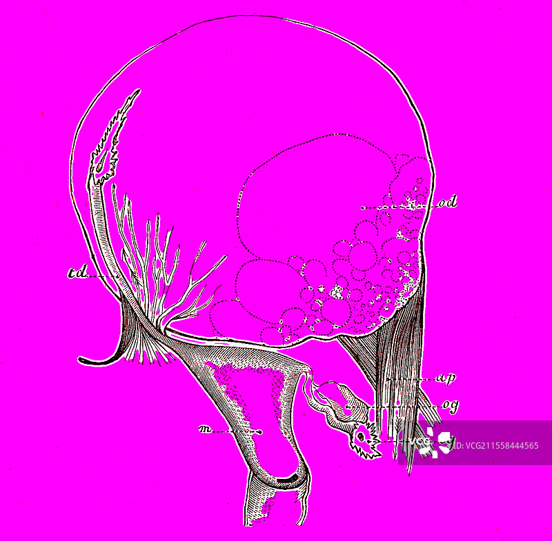 卵巢囊肿插图图片素材