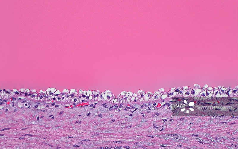 肾细胞癌中的囊性变化，光学显微镜图像图片素材