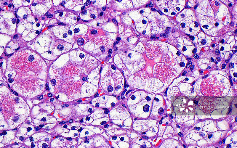 透明细胞肾细胞癌，光学显微镜图像图片素材