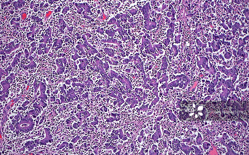 结肠髓样癌，光学显微镜图像图片素材