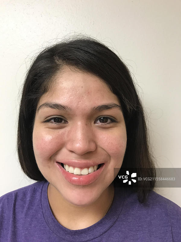 成功治疗痤疮图片素材