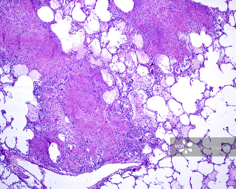 人肺中的结核肉芽肿，光学显微镜图像图片素材