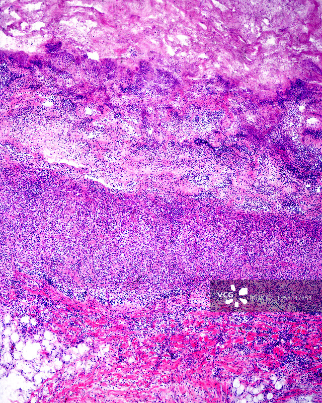 人类心脏中的慢性心内膜炎，光学显微镜图像图片素材