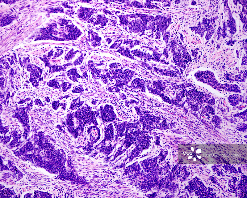 子宫小细胞癌，光学显微镜图像图片素材