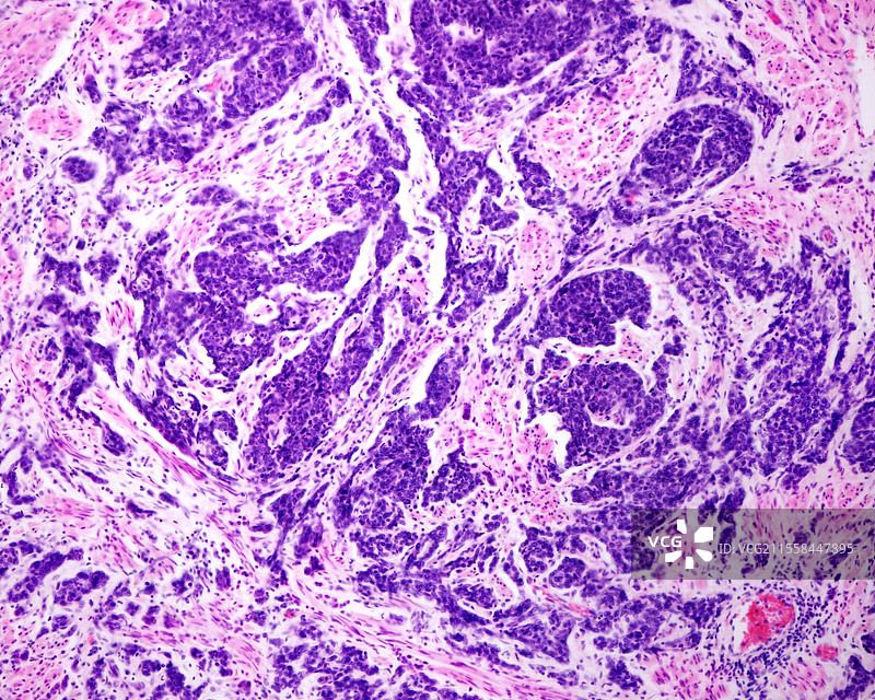 子宫小细胞癌，光学显微镜图像图片素材