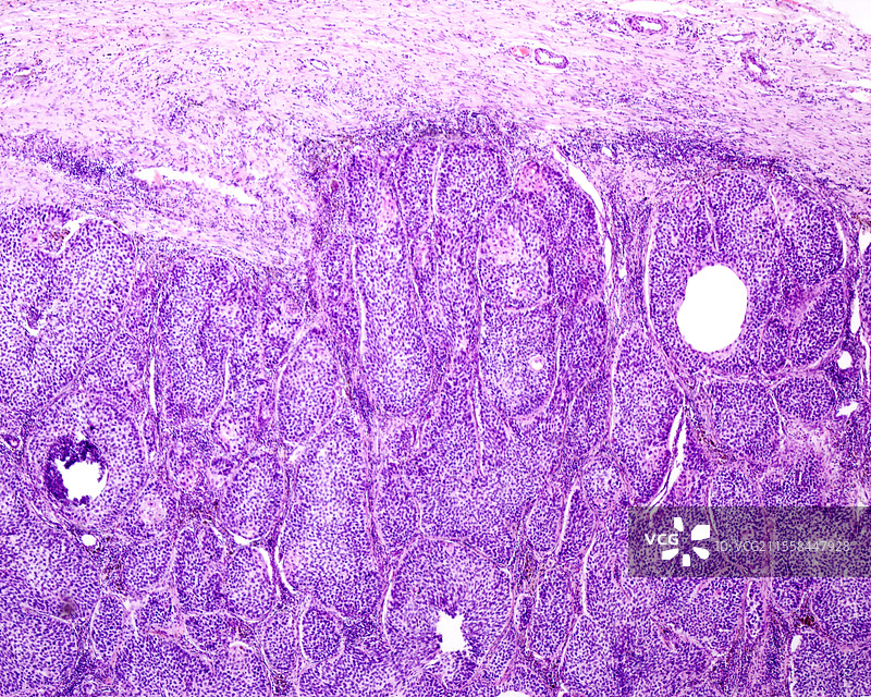 人类肺癌，光学显微镜图像图片素材