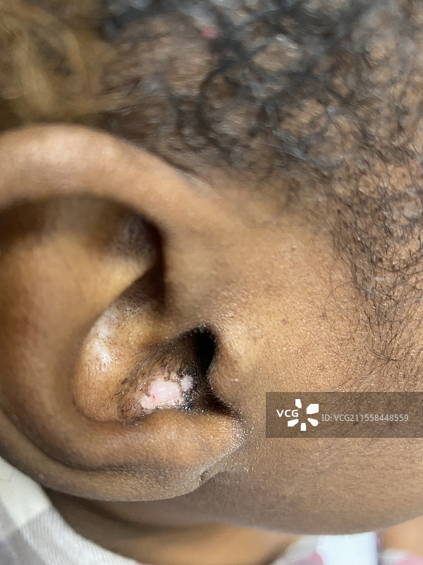 盘状红斑狼疮图片素材