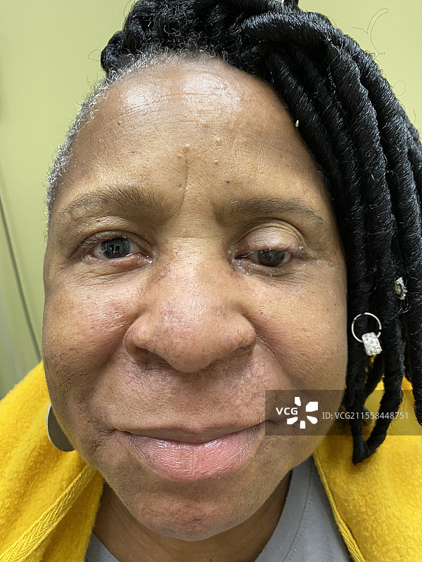 用英夫利西单抗治疗的肉芽肿病图片素材