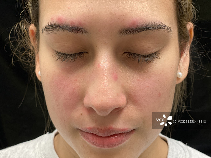 系统性红斑狼疮图片素材