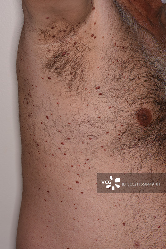 广义性喷发性组织细胞瘤图片素材