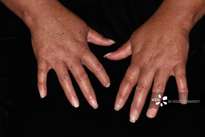 混合性结缔组织病图片素材