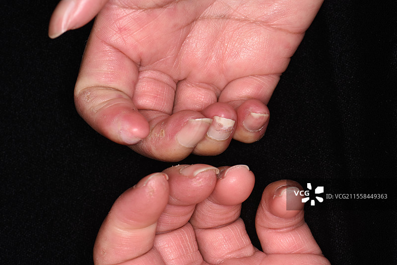 混合性结缔组织病图片素材