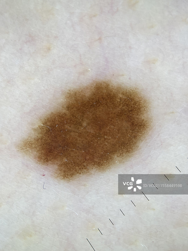 非典型痣，皮肤镜检查图片素材