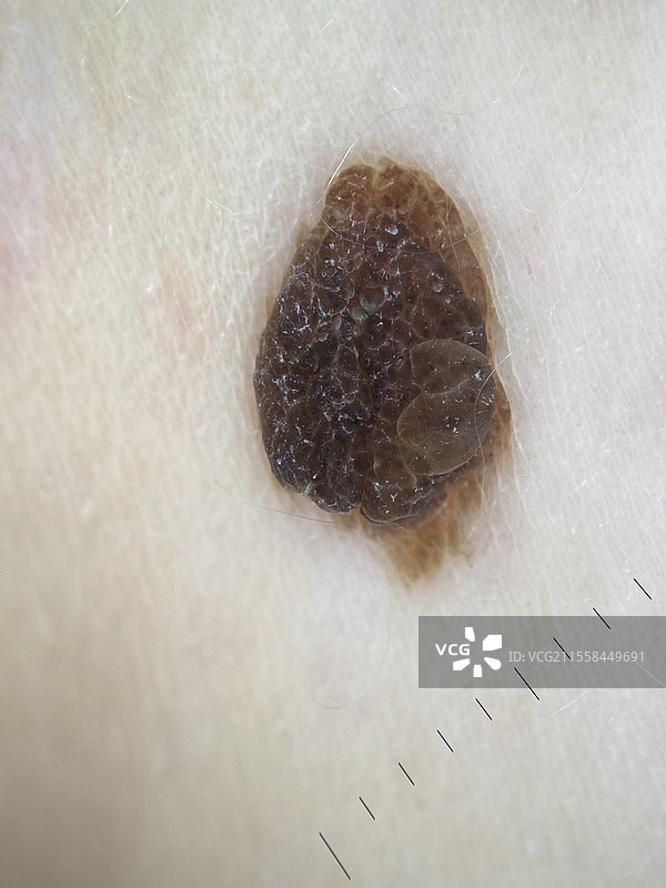 非典型痣，皮肤镜检查图片素材