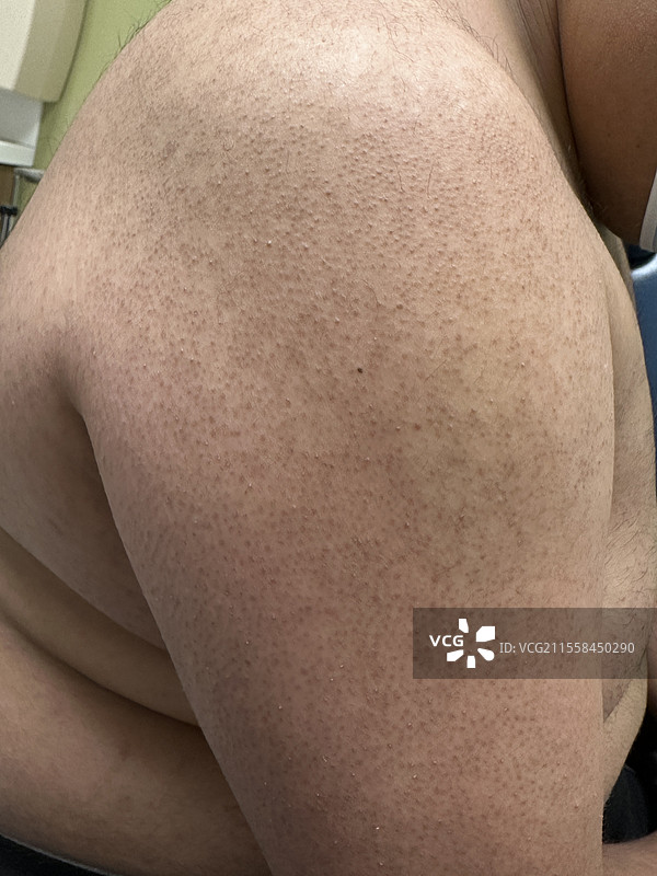 毛囊角化症图片素材