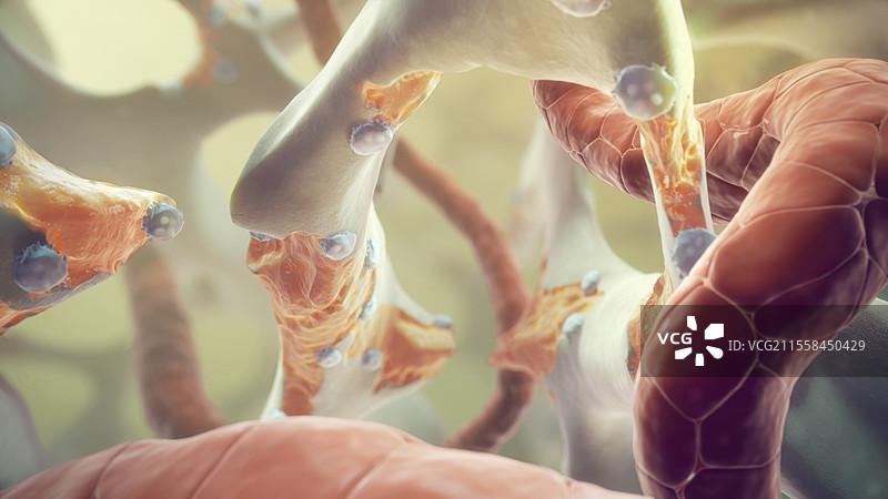 骨质疏松症插图图片素材