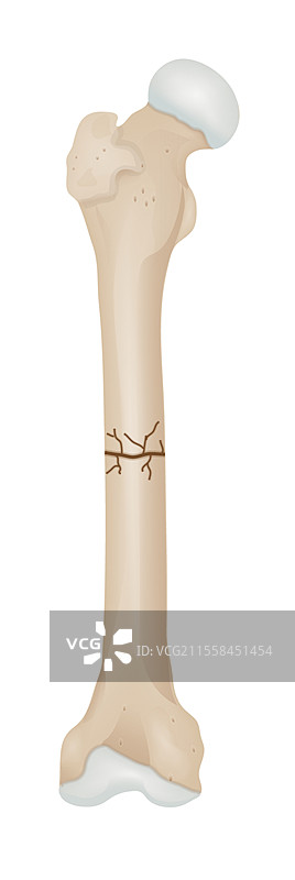 粉碎性股骨骨折插图图片素材