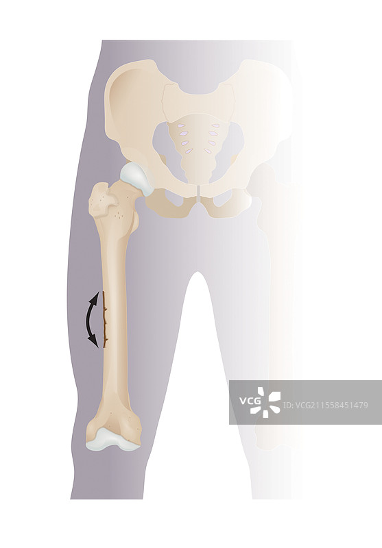 绿色棒状股骨骨折插图图片素材