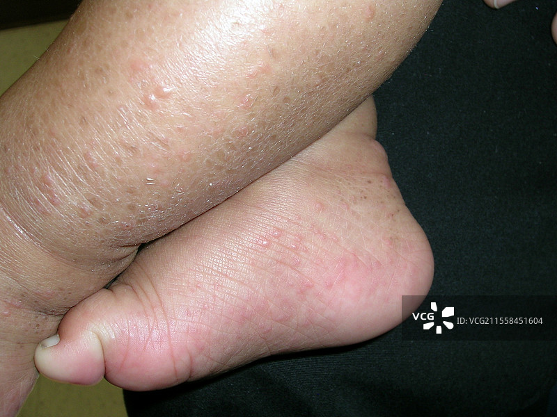 吉安诺蒂-克罗斯蒂综合症图片素材