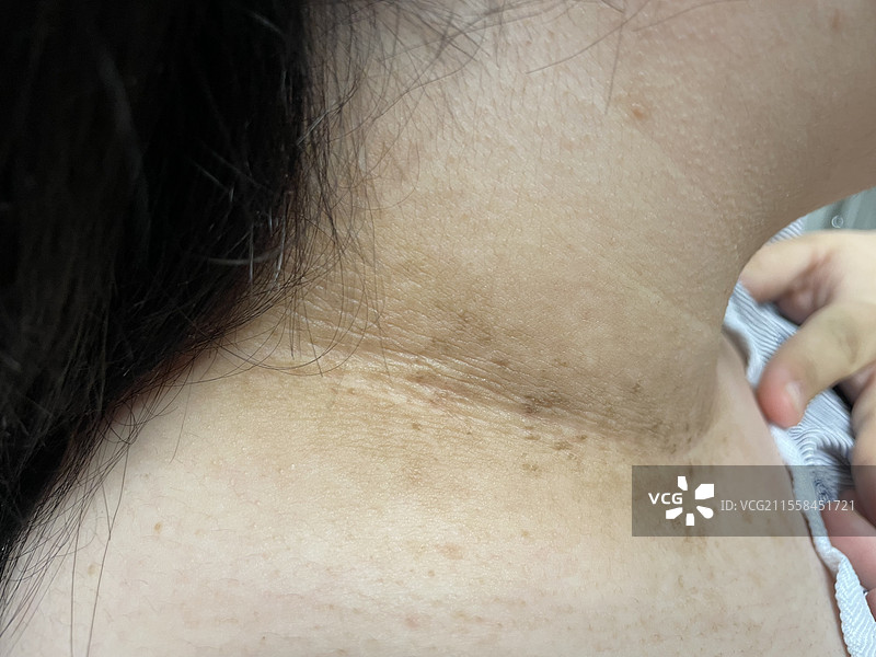 融合性和网状瘤病图片素材