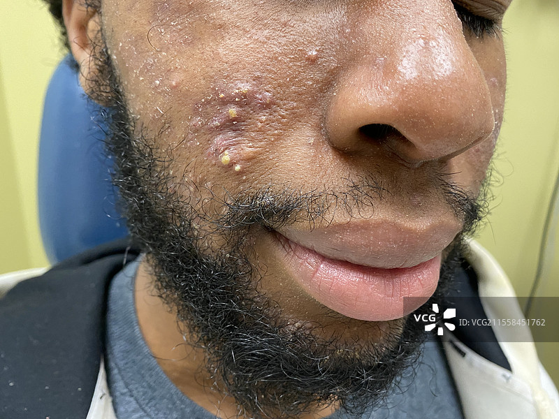 解剖性细菌性皮肤炎图片素材