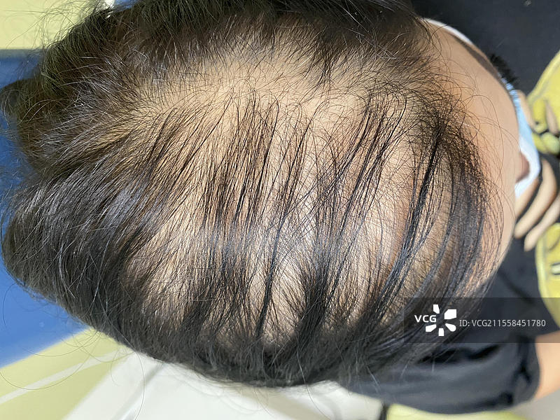 女性型脱发图片素材