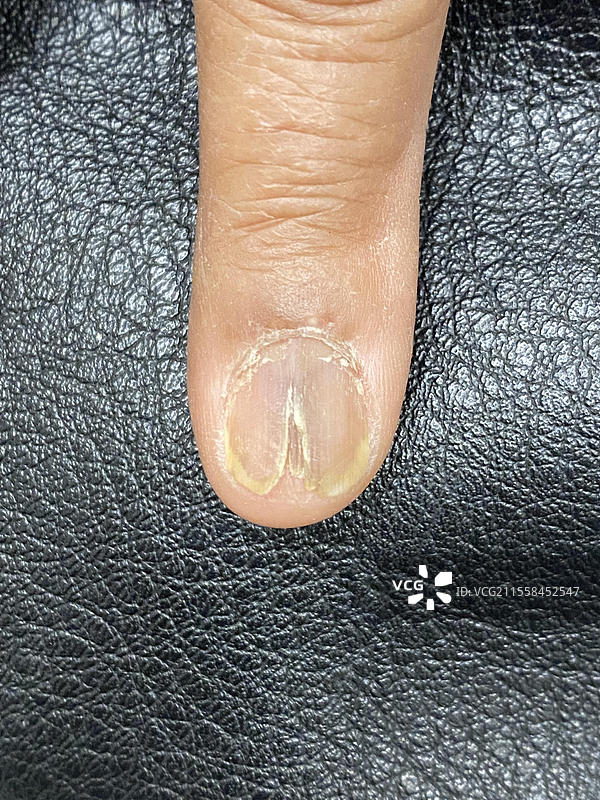 活检后变形的指甲图片素材