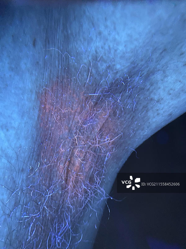 紫外线下的毛癣病和红癣病图片素材