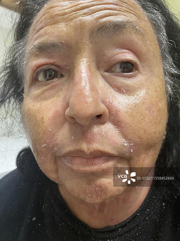 Sebopsoriasis图片素材