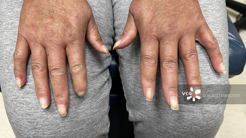 CREST综合症图片素材