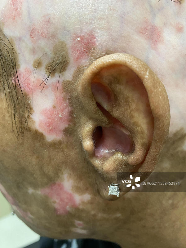 盘状红斑狼疮图片素材