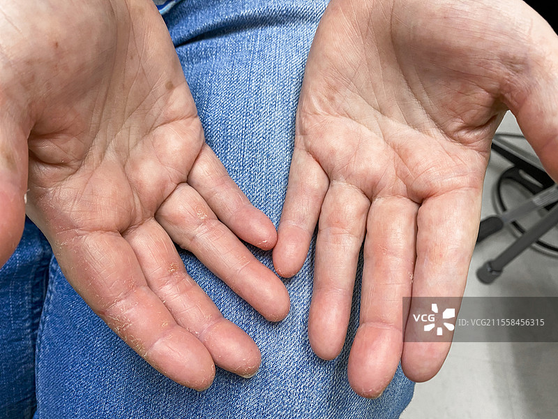 银屑病关节炎图片素材