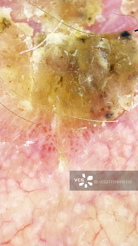 鳞状细胞癌，皮肤镜检查图片素材