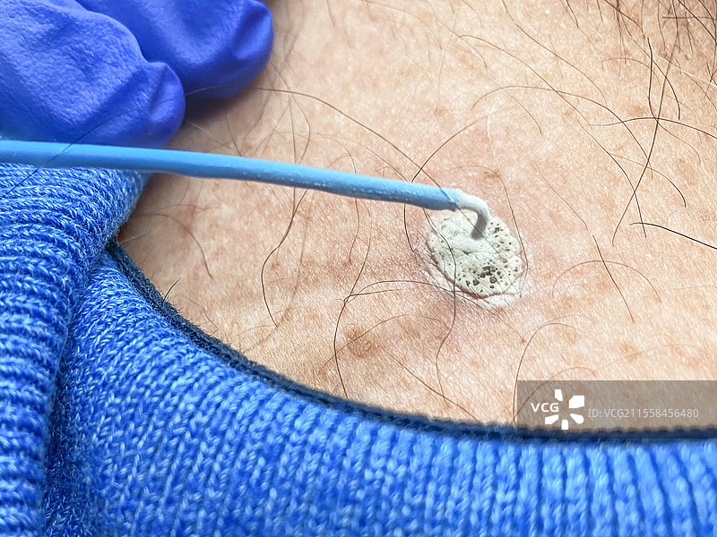 脂溢性角化症的冷冻手术图片素材