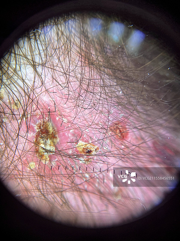 头皮癣，皮肤镜检查图片素材