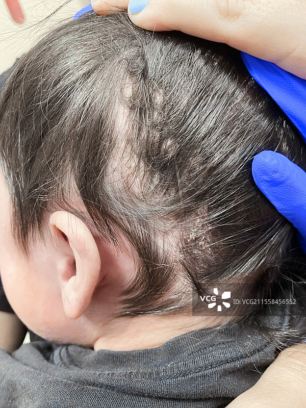 头皮癣图片素材