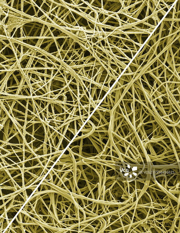 新冠病毒引起的异常血栓，扫描电子显微镜图像图片素材