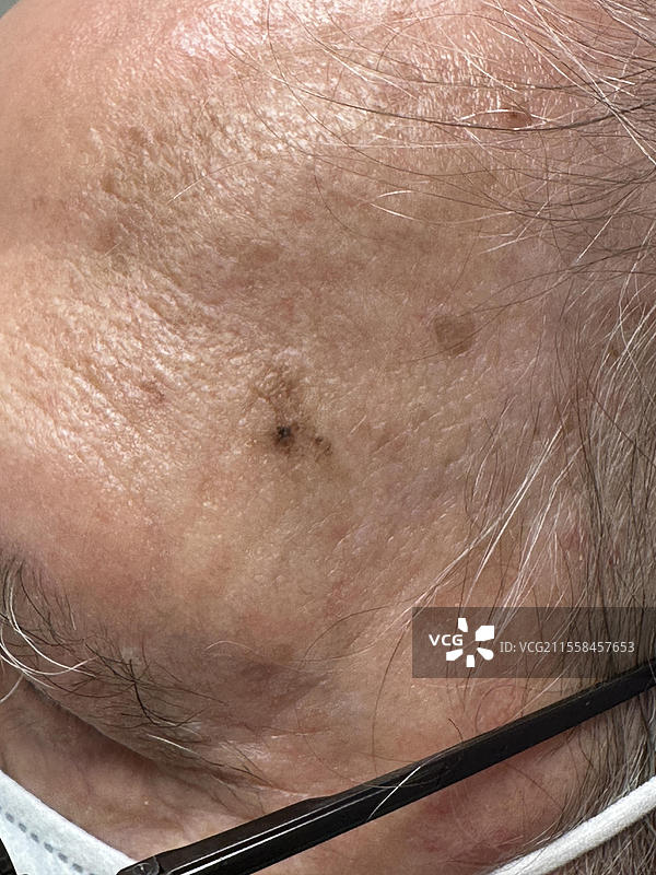 恶性雀斑黑色素瘤图片素材