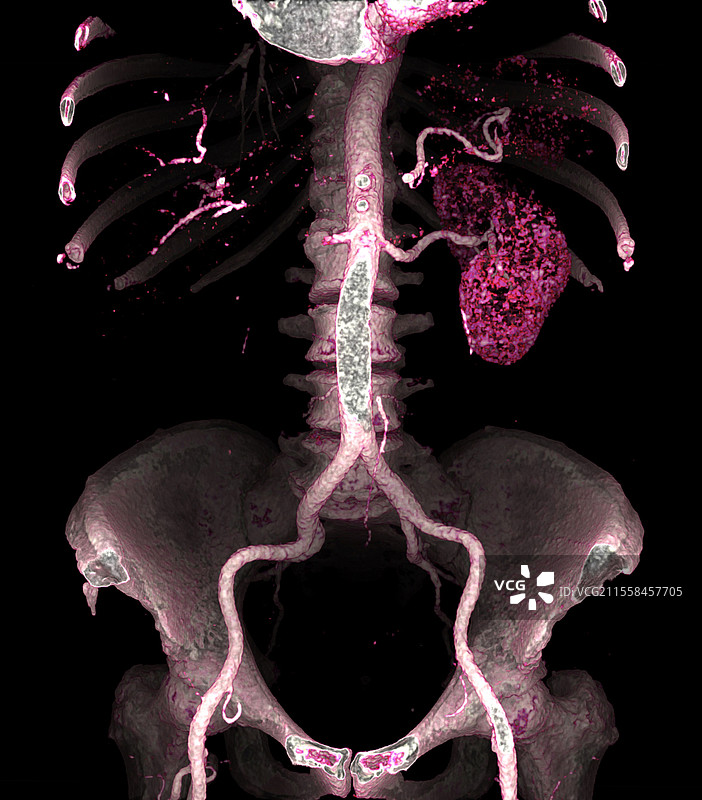 肾梗死，CT扫描图片素材