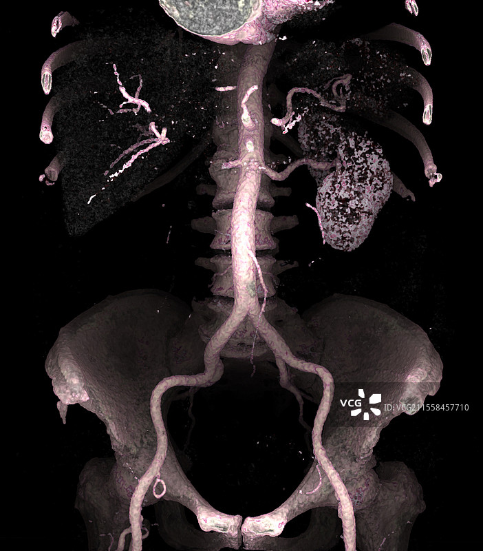 肾梗死，CT扫描图片素材
