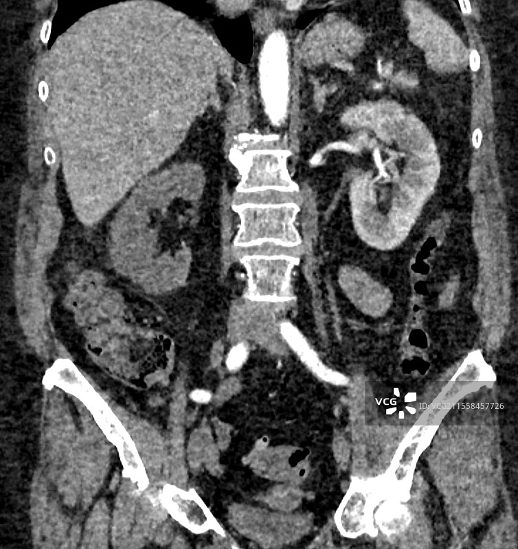 肾梗死，CT扫描图片素材