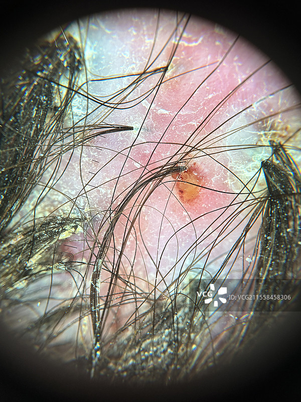 脱发性毛囊炎，皮肤镜检查图片素材