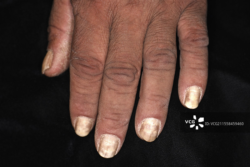真菌指甲感染图片素材