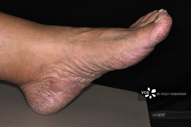 真菌指甲感染和脚气图片素材