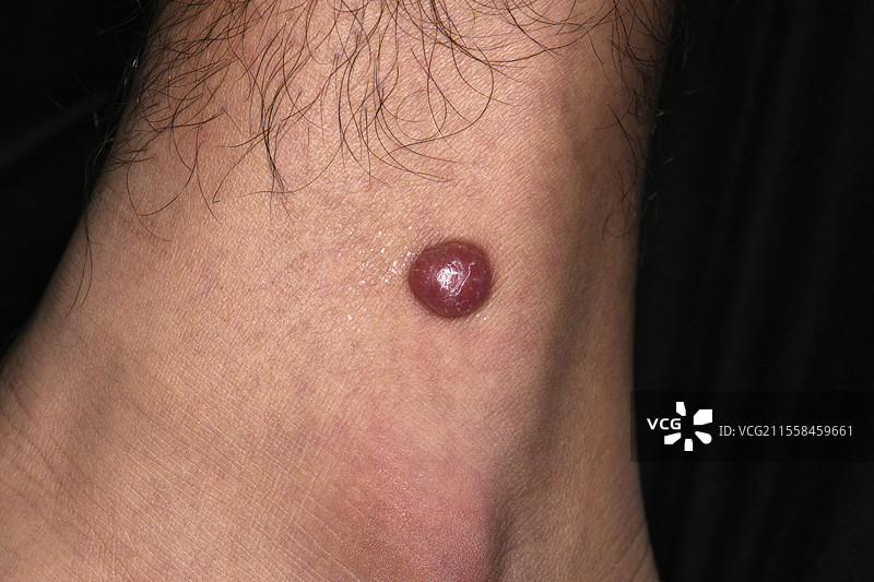 黄granuloma图片素材