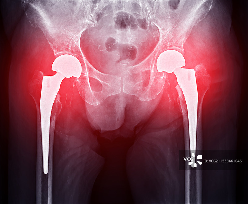 全髋关节置换术，X光片图片素材